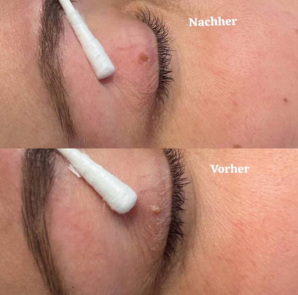 Nahaufnahme eines Augenlids vor und nach einem Eingriff, mit Wattestäbchen und markantem Muttermal.