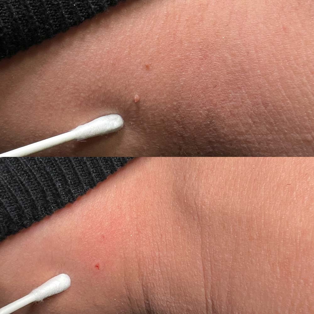 Nahaufnahme einer Haut vor und nach der Entfernung eines Mitessers mit einem Wattestäbchen.